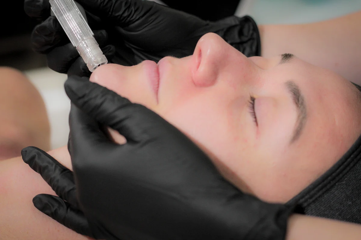 RF-Microneedling-Skin-Rejuvenation-Treatment