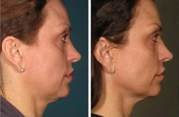before_after_02
