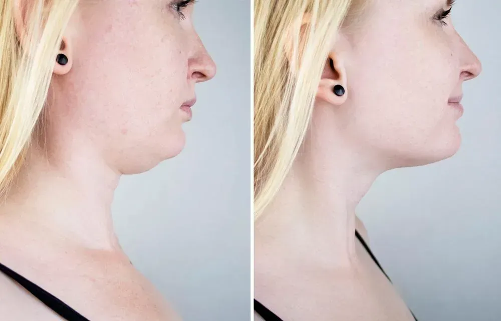 before_after_3